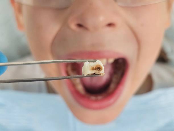 Urgent Tooth Repair in KY